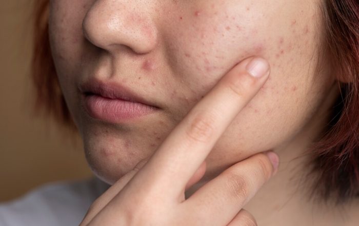 La dermatillomanie, potentiellement associée aux TDAH et TSA